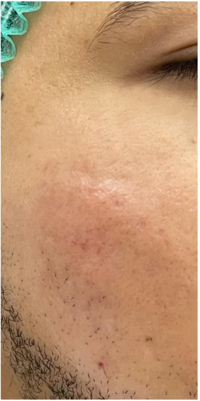 Botox — patas de gallo - después del tratamiento