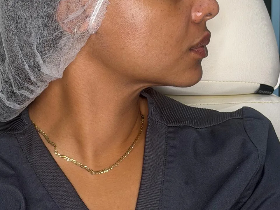 Perfilado mandibular - después del tratamiento