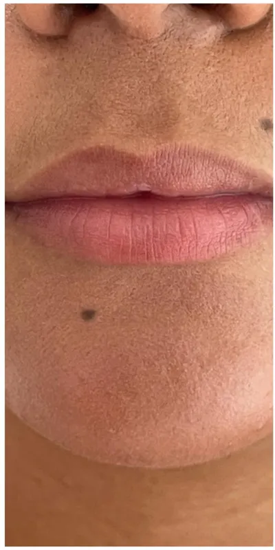 Relleno de labios — caso 2 - antes del tratamiento