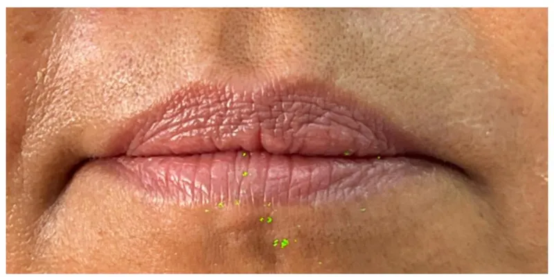 Relleno de labios — caso 3 - antes del tratamiento