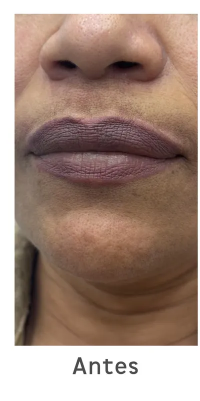 Relleno de labios — caso 4 - antes del tratamiento
