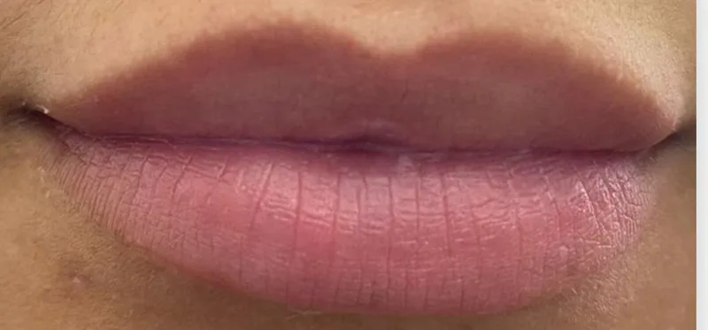 Relleno de labios - antes del tratamiento