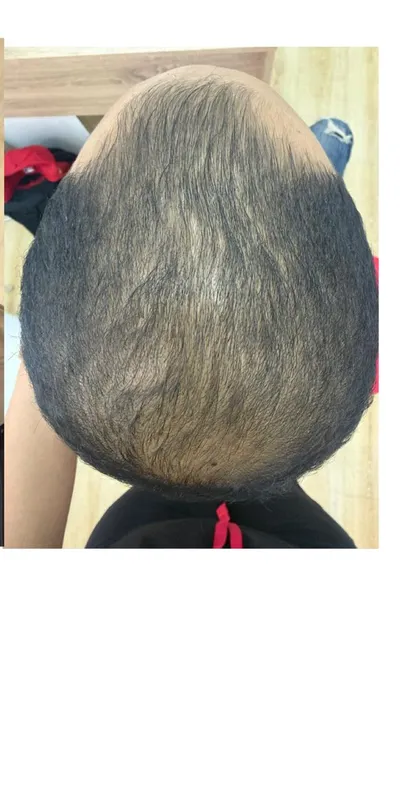 Alopecia androgenética - después del tratamiento